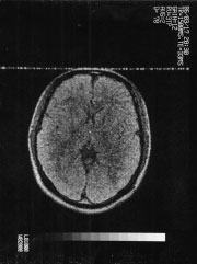 Figure 3. The first head MRI image