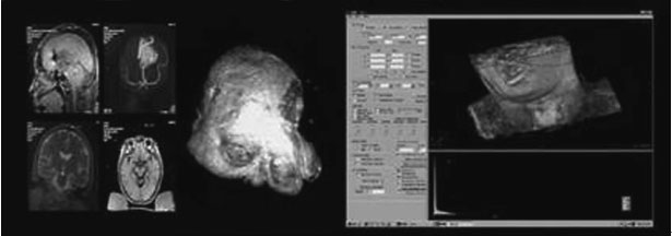 Intraoperative MRI Real-time volume rendering 