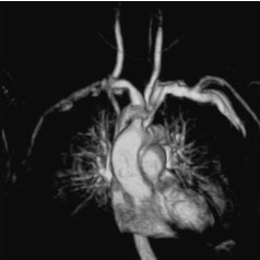 Figure 7. Image of the heart and great vessels (AIRlS II Comfort)