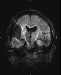 Figure 8. Image of intraoperative DWI (AIRlS II Comfort)