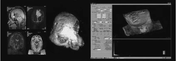 Intraoperative MRI Real-time volume rendering
