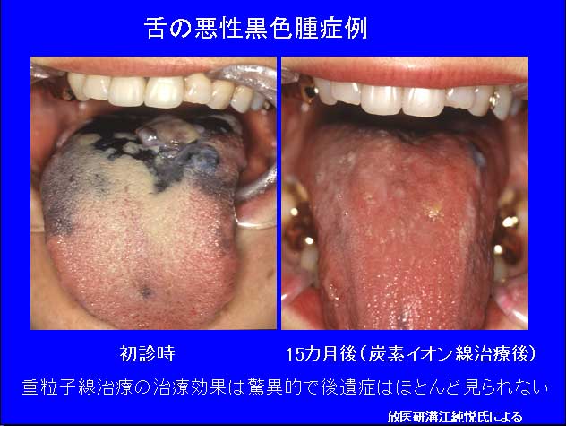 足の黒色腫はどのように治療されますか?